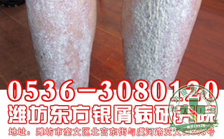 得了银屑病，要注意哪些方面的问题呢?
