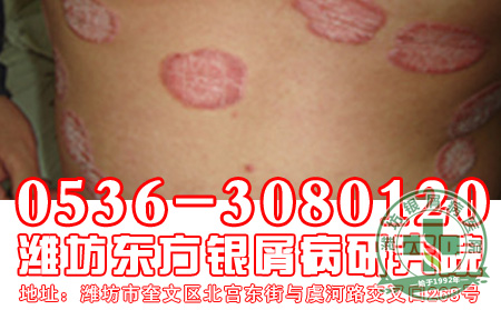 银屑病患者穿掉色的衣服有什么危害呢?