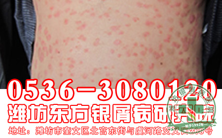 银屑病患者多笑辅助治疗银屑病