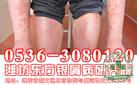 经常坐办公室的牛皮癣患者要做哪些运动呢?