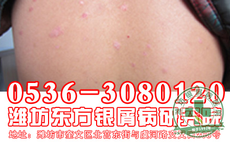 儿童银屑病患者心理治疗的方法有哪些?