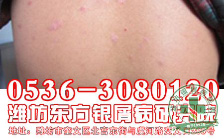 白领是银屑病的易发群体吗?