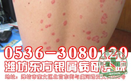 怎样才能治好银屑病呢?