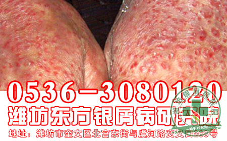国庆节银屑病患者要注意饮食方面的哪些问题呢