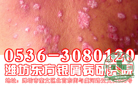 肥胖型银屑病患者在饮食上有什么讲究吗?