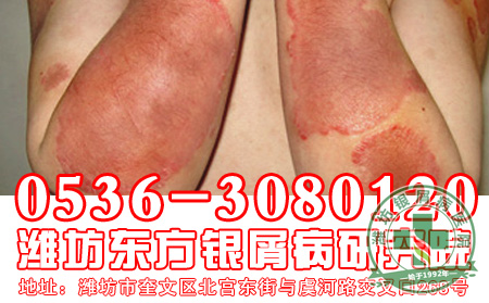 得了牛皮癣，如何避免病情加重呢?