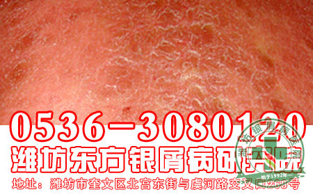 如何选择牛皮癣治疗药物?