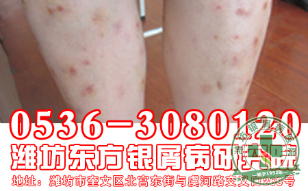 哪些不良的生活习惯会加重牛皮癣患者病情呢?