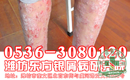 牛皮癣一定要治疗吗?会自愈吗?可以过段时间再治