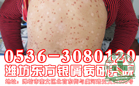 别让牛皮癣遮住你人生的光芒