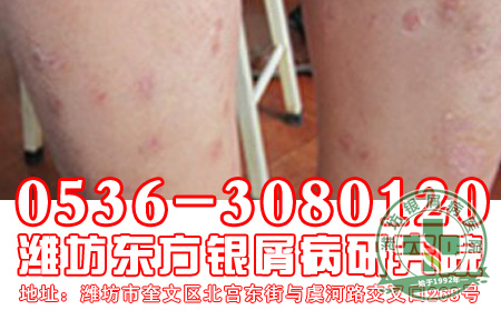 牛皮癣常见的治疗方法有哪些?