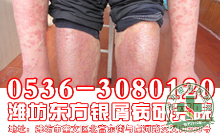 牛皮癣治疗的六大注意事项