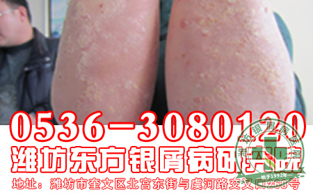 牛皮癣患者出现皮肤瘙痒的时候要注意什么