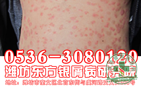 银屑病患者用药要注意什么