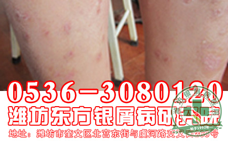 老年牛皮癣患者冬季如何养生