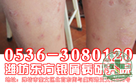 牛皮癣治疗的好帮手--心理治疗