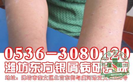 特别关注：牛皮癣治疗的误区