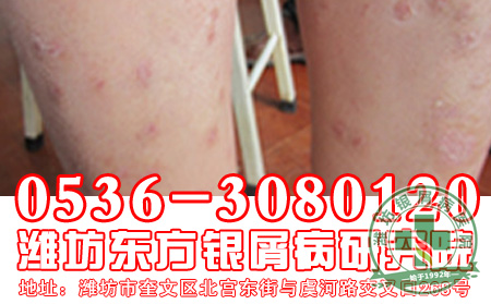 银屑病患者午后小睡要讲究