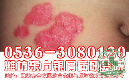 银屑病预防复发大全