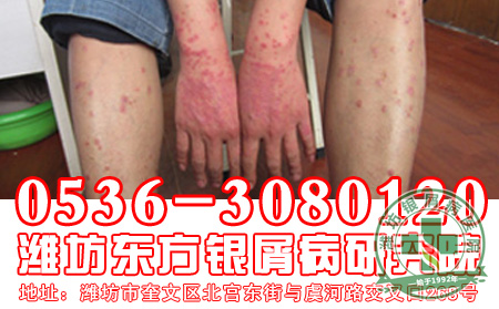 进行期的牛皮癣怎么护理