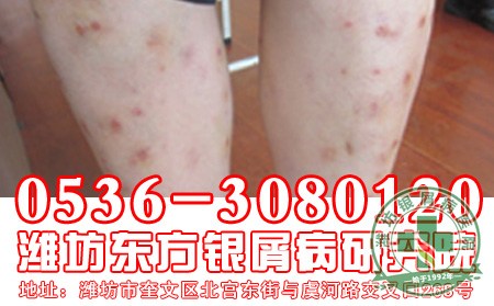 牛皮癣患者冬季如何御寒呢