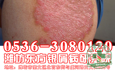 四大原则预防银屑病复发
