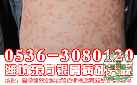 银屑病患者可以食用海参吗