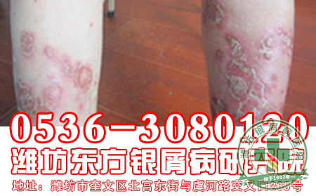 银屑病的皮损有什么特征