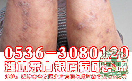 银屑病患者午睡有什么好处