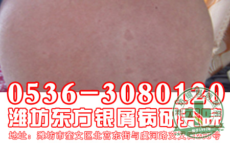 烟草和银屑病
