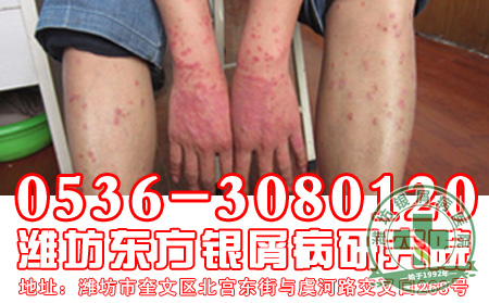 银屑病患者宜吃哪些蔬菜呢