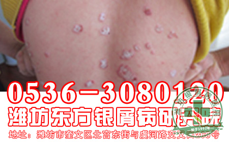 生活中哪些因素容易诱发银屑病