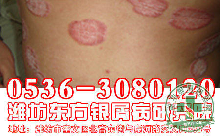 针对银屑病济南治疗银屑病医院主任建议