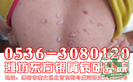 通过血液可以传染牛皮癣吗