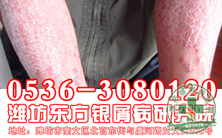 银屑病患者适合做哪些运动