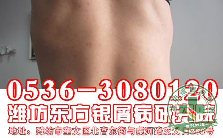 牛皮癣初期应该吃什么