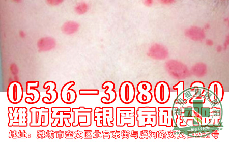 头上长牛皮癣应该怎样护理