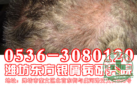 济南银屑病治疗哪家医院好