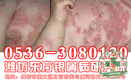 儿童银屑病治疗应该注意什么