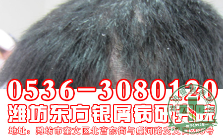银屑病患者夏天应该怎样穿衣呢