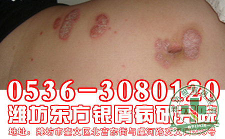 银屑病患者吃大蒜有哪些好处