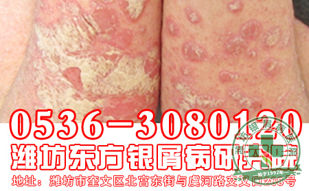 儿童银屑病治疗应该注意什么1