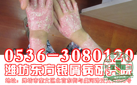主任答疑：银屑病如何诊断？