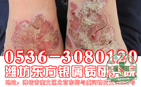 合理食用南瓜,赶走银屑病!