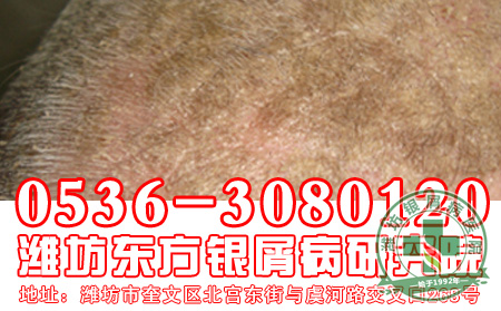银屑病常见专用词汇解释【平价医院】