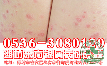 老年银屑病好发于男性的原因是啥？