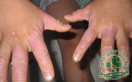 济南患者：七年的银屑病哪里能治好？