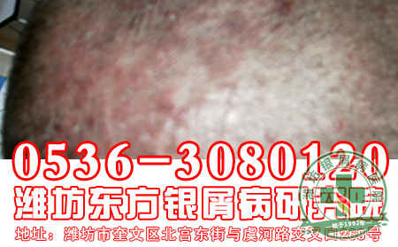 银屑病冬季运动应该遵循什么原则？【新闻专题