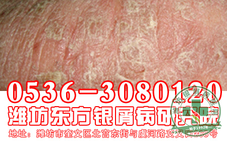 中医治疗银屑病是不是会有奇特的效果出现？【