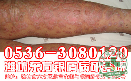 银屑病患者感冒吃什么好？